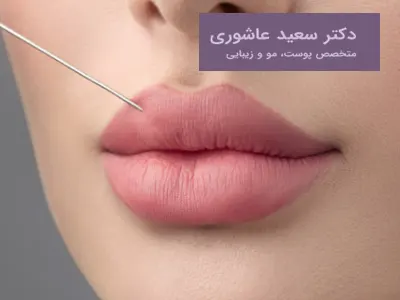 تزریق ژل لب عروسکی