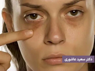 طریقه تزریق چربی زیر چشم 