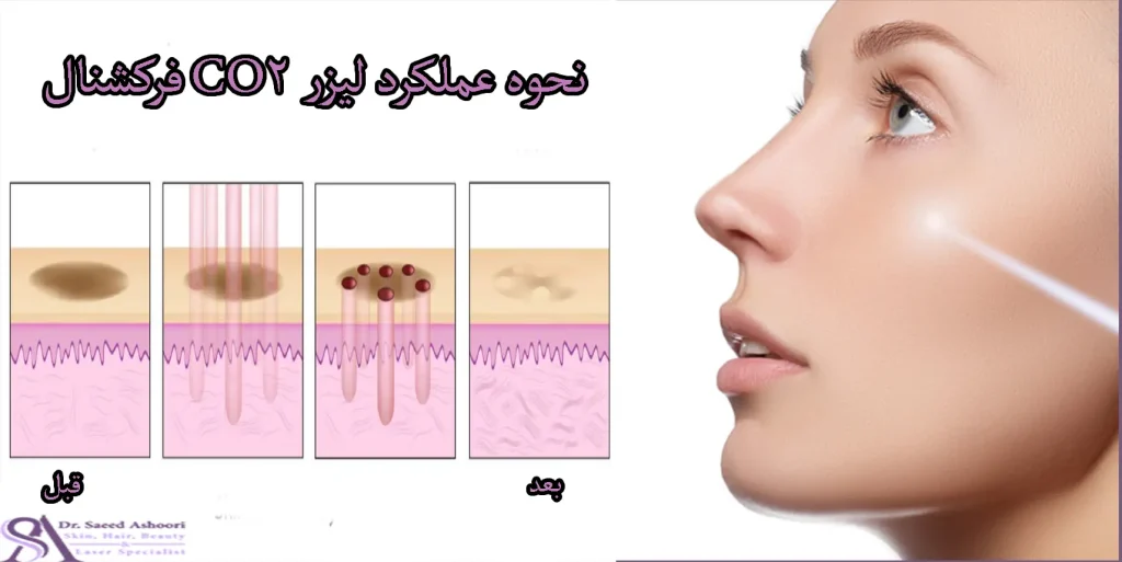 نحوه عملکرد لیزر CO2 فرکشنال